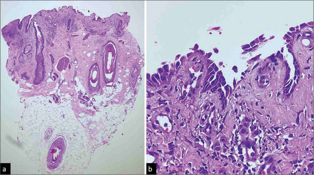 Pemphigus vulgaris. (a) Epidermis is lost due to suprabasal clefting and only the basal layer is seen. Note the suprabasal clefting extending into the hair follicles. Moderately dense upper dermal perivascular infiltrate is seen [Haematoxylin and eosin (H and E), x40], (b) Basal layer showing ‘row of tombstone’ appearance with basal keratinocytes separated from each other but attached to the basement membrane (H and E, ×400).