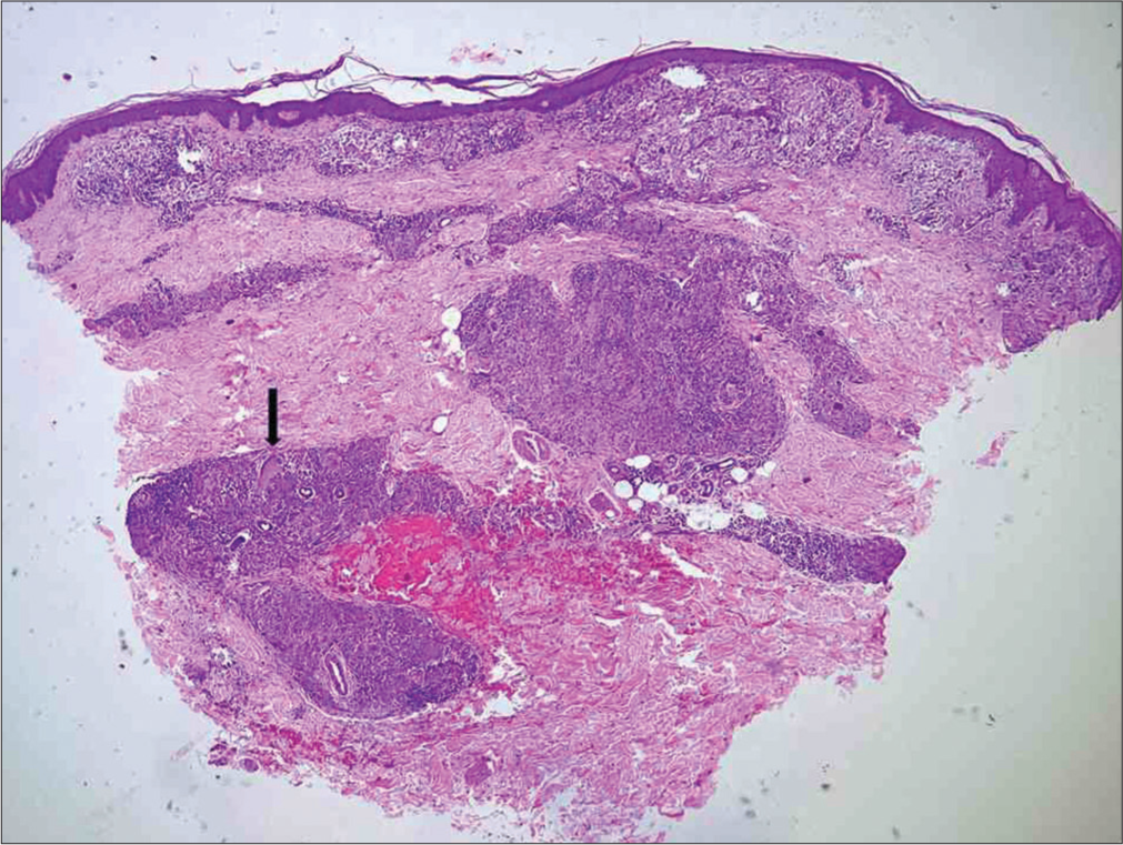 Borderline tuberculoid Hansen’s disease. Thin flat epidermis with upper and mid-lower dermis showing multiple well circumscribed, sinuous, oblong, curvilinear infiltrate around adnexa and neurovascular bundles, referred to as leprosy pattern. Multiple Langhans’ giant cells (black arrow), epithelioid cells and lymphocytes are seen [Haematoxylin and eosin (H and E), x40].