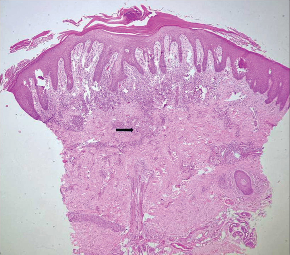 Lupus vulgaris. Irregular epidermal hyperplasia with hyperkeratosis and focal parakeratosis, upper dermal lichenoid granulomatous infiltrate and discrete epithelioid granulomas with giant cells (black arrow) in mid-lower dermis with intervening dermis showing areas of fibrosis [Haematoxylin and eosin (H and E), x40].