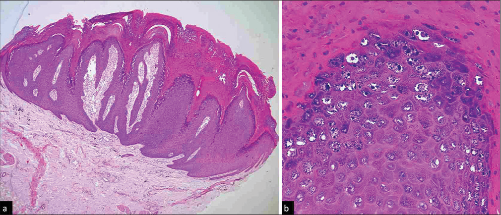 Verruca vulgaris. (a) Papillomatosis with prominent incurving of rete ridges at both the sides, hyperkeratosis with parakeratotic columns at the summit of papillary elongations and underlying hypogranulosis. Dilated blood vessels in papillary dermis and presence of blood in stratum corneum are important findings in wart [Haematoxylin and eosin (H and E), x100], (b) Upper epidermal keratinocytes showing human papillomavirus (HPV) virus induced cytopathic changes in the form of prominent coarse keratohyaline granules, basophilic cytoplasmic inclusions, shrunken nucleus (koilocytes). Also note the stubby parakeratosis (H and E, ×400).