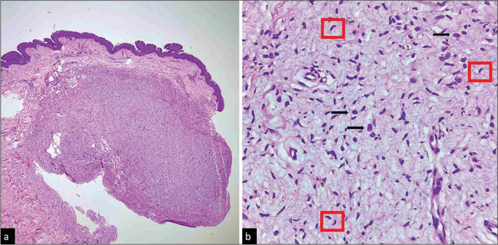 Neurofibroma. (a) A dermal fairly well-defined non-encapsulated tumour composed of spindle cells [Haematoxylin and eosin (H and E), ×40], (b) High magnification showing loosely arranged Schwann cells with characteristic S-shaped wavy nucleus with tapering ends (also described as buckled nucleus with slight bent in centre, resembling ‘diving dolphins’) (red boxes), along with mast cells with characteristic fried egg appearance (black arrows). Note the loose myxoid stroma (H and E, ×400).