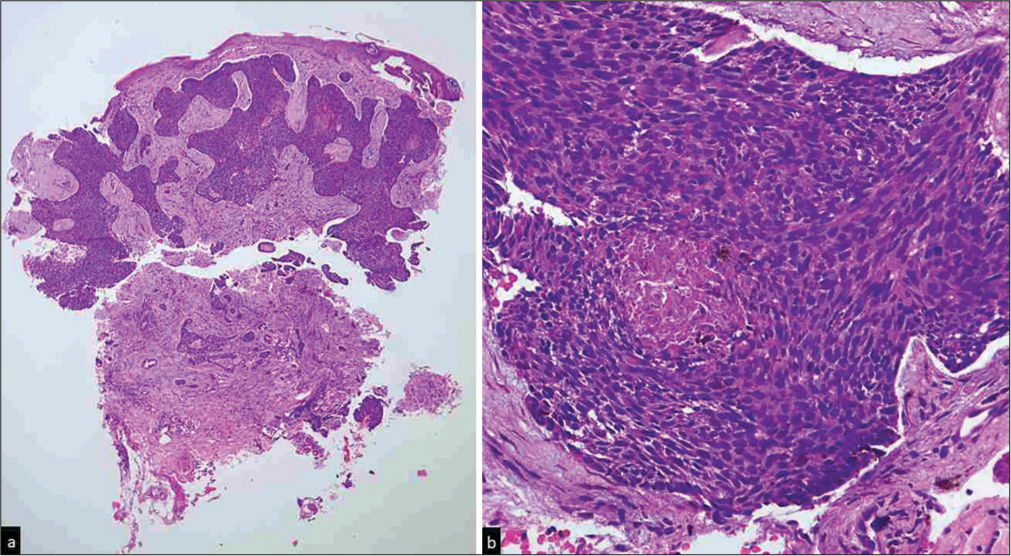 Basal cell carcinoma. (a) Multiple irregular tumour islands composed of basaloid cells with peripheral palisading and prominent retraction artefact between tumour nodules and mucinous stroma [Haematoxylin and eosin (H and E), x40], (b) The tumour cells have deeply basophilic large oval elongated nucleus and scant cytoplasm. Note the eosinophilic amorphous area of necrosis in the centre of the tumour nodule (H and E, ×400).