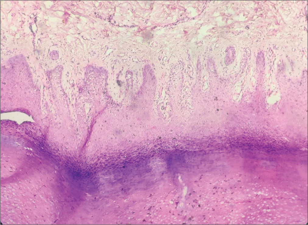 Haematoxylin and eosin stained section (×100) of skin showing hyperkeratosis and prominent keratohyaline granules with perivascular lymphocytic infiltrate.