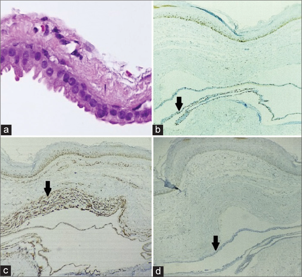 (a) Histopathological examination (100x) shows inner layer of columnar cells, Immunohistochemical staining shows (b) p63 positive (black arrow), (c) Smooth muscle actin positive (black arrow), (d) Her2neu negative (black arrow).