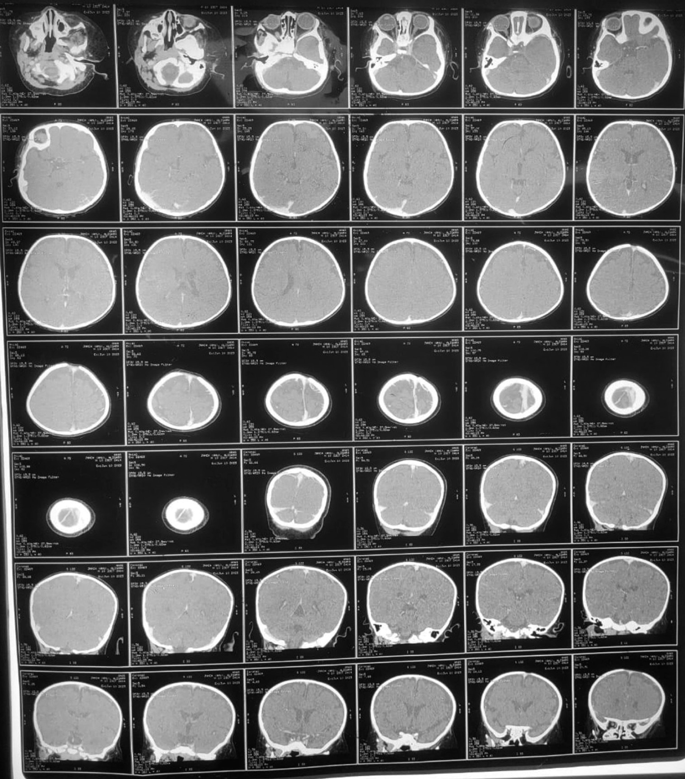 Contrast-enhanced computed tomography head showing large non-capsulated subcutaneous fat extending from left parietal bone to angle of mandible with fatty infiltration of left parotid gland, masseter, temporalis, buccinator, lateral and medial pterygoid muscles, intrinsic and extrinsic muscles of the left side of tongue muscle, hypertrophied condylar process, hypertrophy of left mandible and left zygomatic arch.