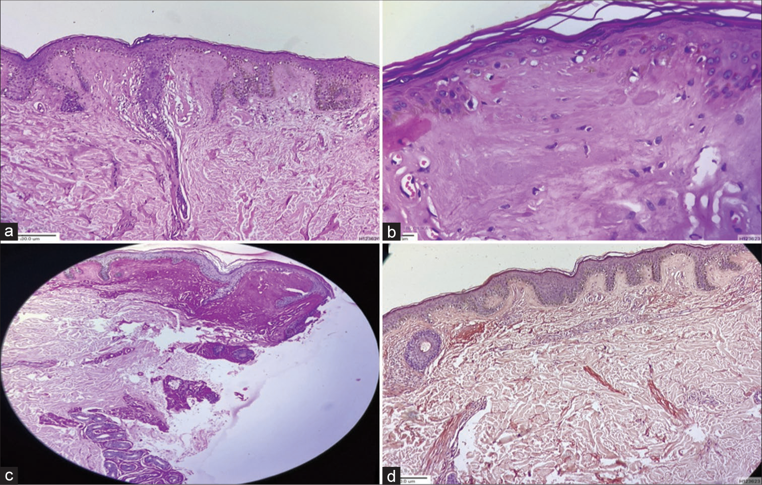 (a) Hyperkeratosis and eosinophilic amorphous deposits in upper dermis [Haematoxylin and Eosin (H&E), ×10], (b) Hyaline deposition in the papillary dermis (H&E, ×40), (c) Periodic acid-Schiff (PAS) positive hyaline material in the dermis and surrounding adnexal structures (H&E with PAS, ×40) and (d) Congo Red positive amyloid deposits in the dermis (Congo Red stain, ×10).