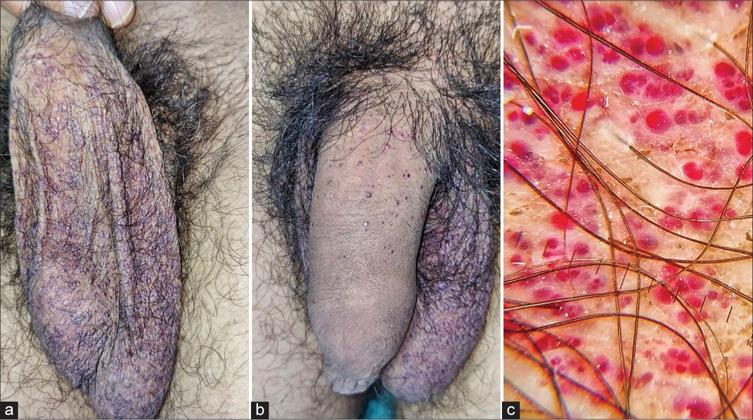 (a) Multiple angiokeratomas present over the scrotum, (b) Multiple angiokeratomas seen over the shaft of penis, (c) Dermoscopy shows sharply demarcated group of dusky red and dark blue lacunae with whitish veils surrounding them (Heine NC2, ×10).