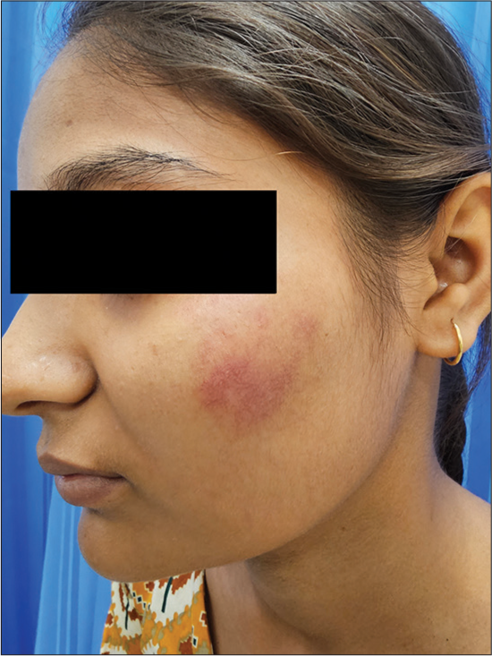 Red coloured flat lesion present on the left cheek.