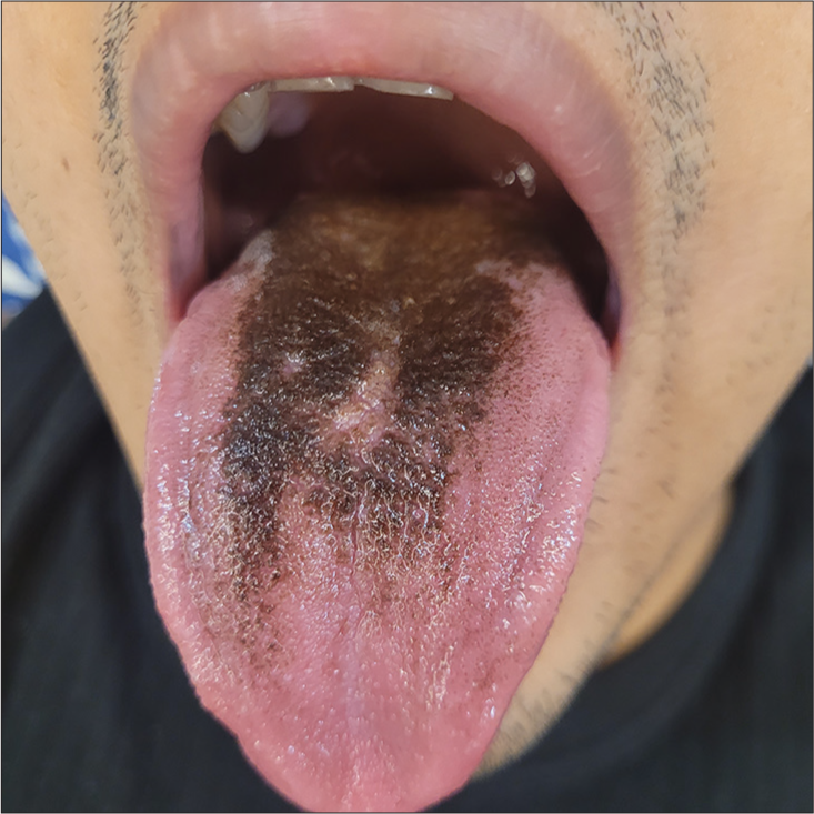 Brownish-black discolouration on the posterior aspect of the tongue 2 weeks after Linezolid therapy.