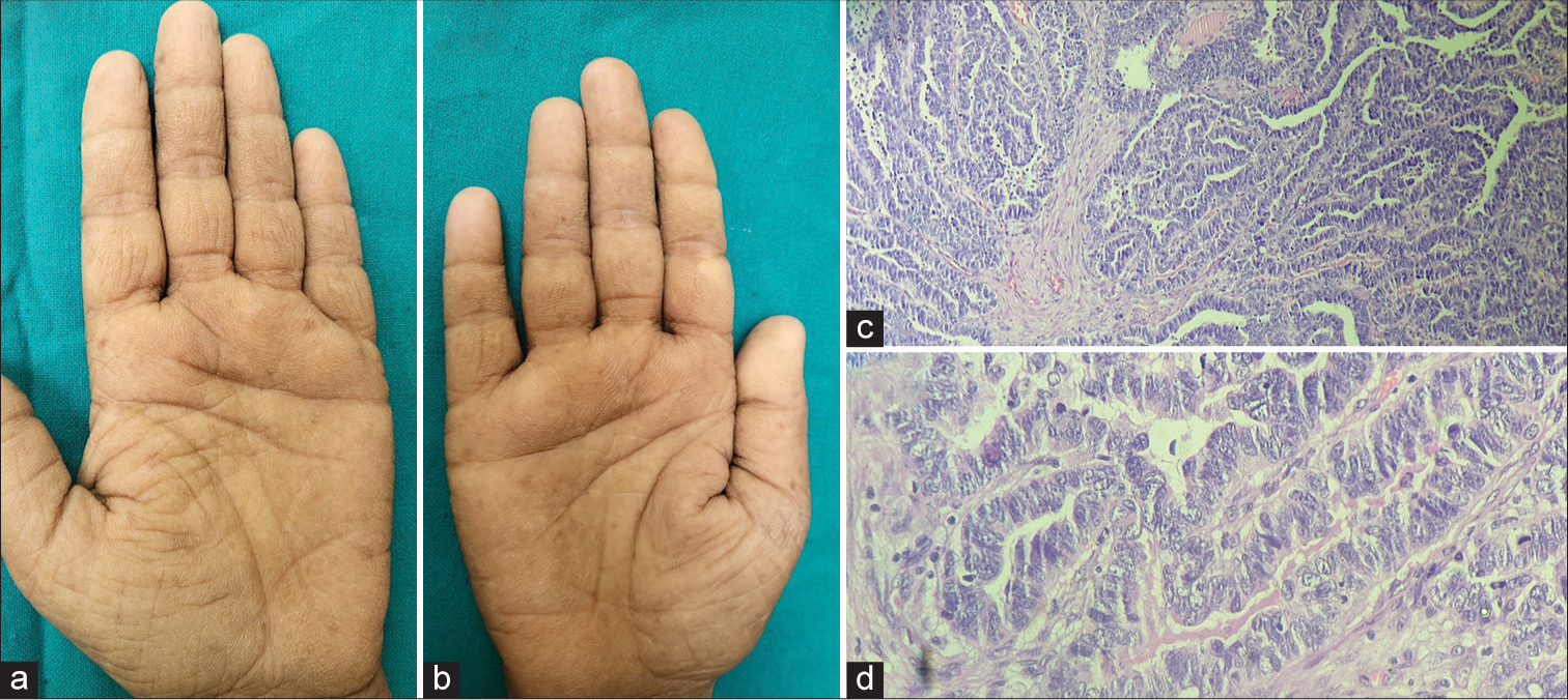 Tripe palms involving (a) left and (b) right hand. (c) Photomicrograph showing tumour arranged in papillary configuration with hierarchical branching pattern (Haematoxylin and Eosin Stain [H&E], ×100). (d) Photomicrograph showing malignant cells exhibiting nuclear polymorphism, nuclear overlapping and prominent nucleoli. (H&E, ×400).