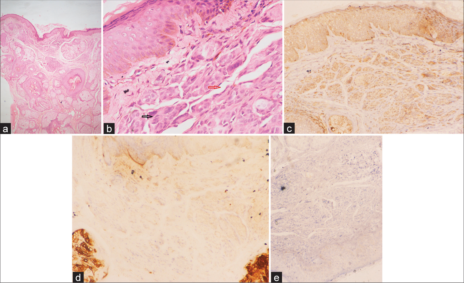 Photomicrographs of skin biopsy. (a) Photomicrograph of skin biopsy showing epidermis and dermis with marked proliferation of sebaceous glands, many of the sebaceous ducts are superficially located and not associated with hair follicles (Haematoxylin and Eosin (H&E) stain, 10×). (b) A small area in the superficial dermis with the presence of basaloid cell islands (black arrow) with surrounding retraction artefacts was noted in the form of clear spaces (red arrow) (H&E stain, 20×). (c) These basaloid tumour cell islands show mild-to-moderate membranous positivity for BerEP4 [Immunohistochemistry (IHC) stain, 20×]. (d) Epithelial membrane antigen (EMA) immunostain is negative in basaloid tumour cell islands but highlights sebaceous glands (IHC stain, 40×). (e) Melan-A immuno-stain is negative in basaloid tumour cell islands (IHC stain, 20×).