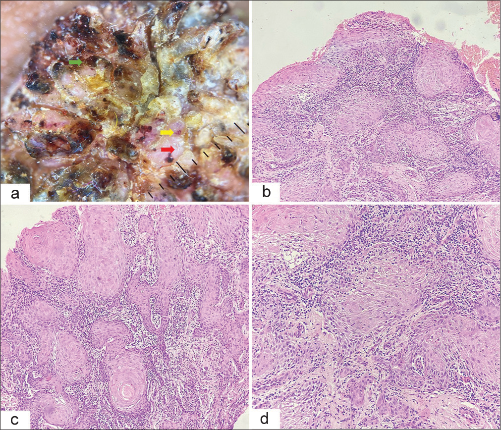(a) Dermoscopy. Milky red structureless areas (red arrow), blood spots on keratin scales (green arrow) and polymorphous vascular patterns (Coiled and looped) (yellow arrow). (×10, DL4 Dermlite, non-polarised). Histopathology. (b) Epidermis showing parakeratosis, downward elongation of rete ridges. Upper dermis showing invasion of islands of squamous epithelium surrounded by lymphocytic reaction and (c) keratin pearls. [Haematoxylin and eosin (H&E), ×10] (d) Islands of squamous epithelium and lymphocytic reaction. (H&E, ×40).