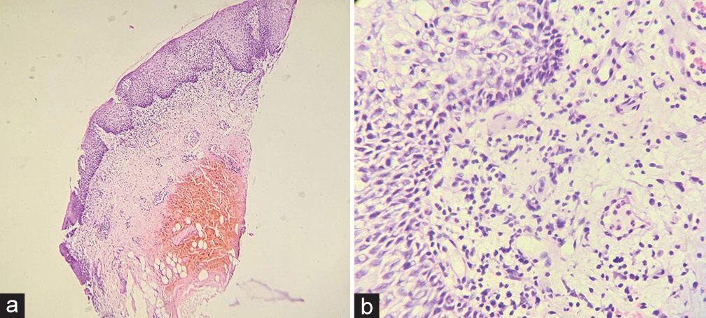 (a) Photomicrograph reveals stratified squamous epithelium with irregular acanthosis, oedematous subepithelial stroma with areas of haemorrhage in deeper aspects of the stroma [Haematoxylin and eosin (H&E) stain, ×10]. (b) Irregular acanthosis with mild transcytosis of lymphocytes and polymorphs with perivascular and interstitial inflammation comprised of lymphocytes and plasma cells. No granuloma or minor salivary glands could be found (H&E stain, ×40).