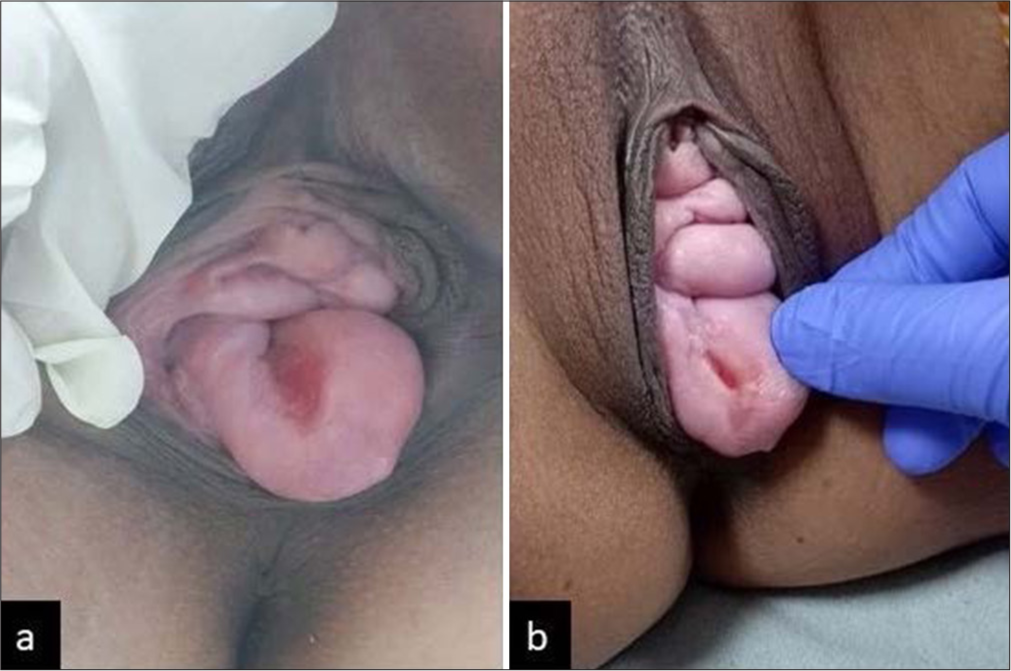 (a) Single ulcer with indurated base before treatment, (b) Healed ulcer after treatment.