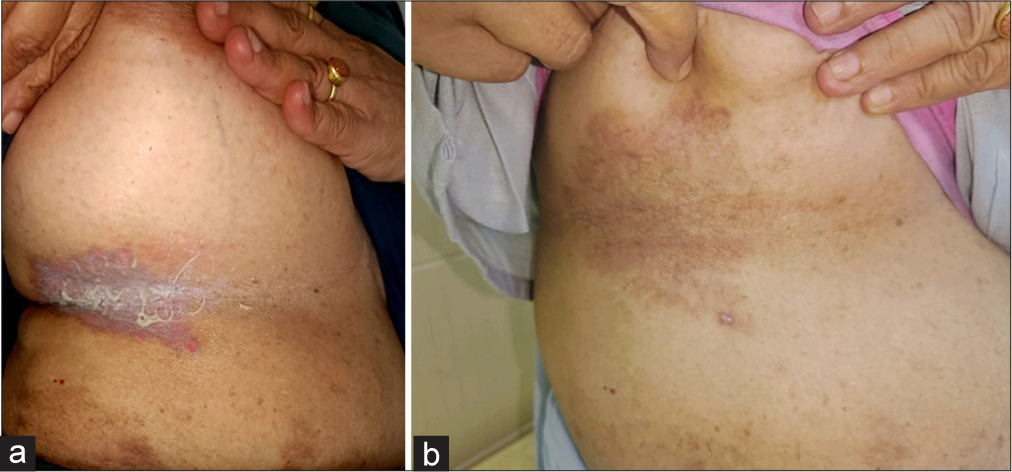 (a) Before treatment erosive lesion with greyish slough and maceration in the inframammary area. (b) After treatment complete resolution of the lesion with PIH in the right inframammary area.
