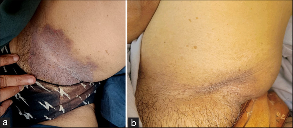 (a) Before the initiation of treatment hyperpigmented patches with maceration in the groin. (b) After treatment complete resolution of the lesions of the left groin.