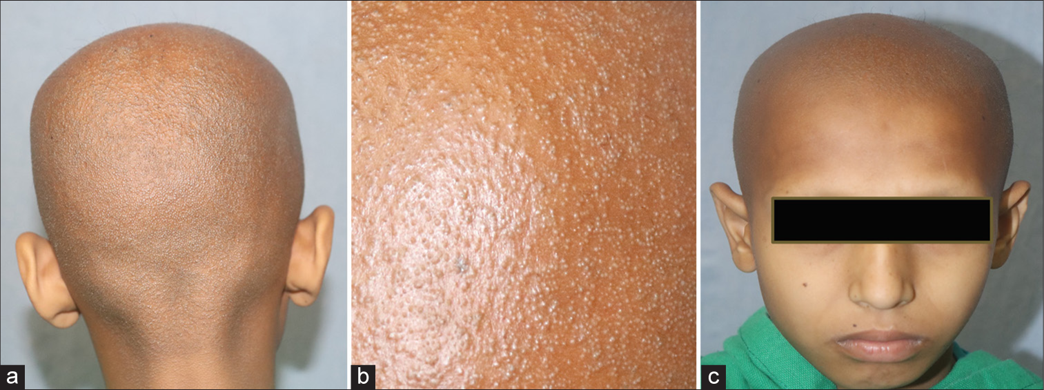 (a-b) Multiple skin-coloured follicular papules on scalp and (c) eyebrows with non-scarring universal alopecia.