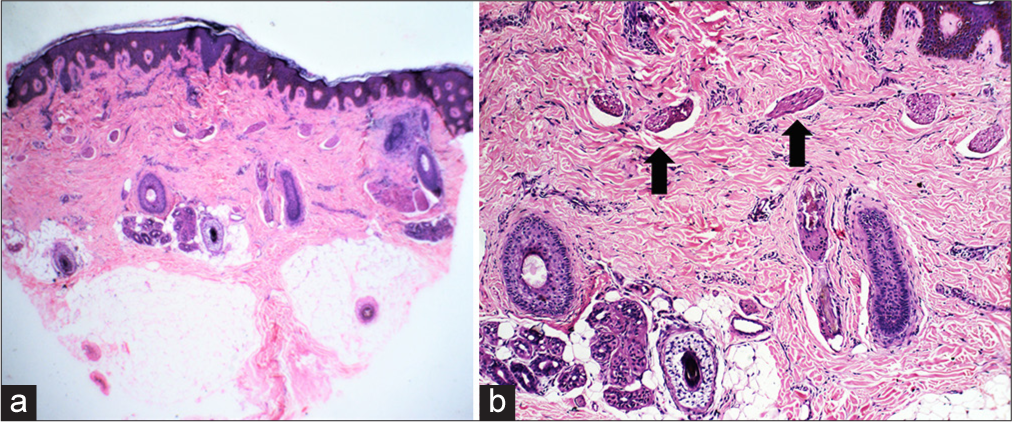 (a) Haematoxylin and eosin (H&E): ×40 and (b) H&E: ×100- Sparse superficial lymphohistiocytic infiltrate with increased number of arrector pili (black arrows) with normal number of follicles representing telogen-anagen units suggestive of non-scarring alopecia.