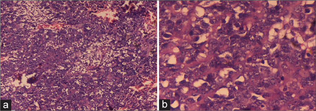(a) Section shows diffuse infiltration of dermis by intermediate to large atypical cells reaching up to the epidermis. Haematoxylin and Eosin ×10. (b) Section shows diffuse infiltration of dermis by intermediate to large atypical cells with hyperchromatic nucleus, irregular nuclear membrane and scant eosinophilic cytoplasm. Haematoxylin and eosin ×40.