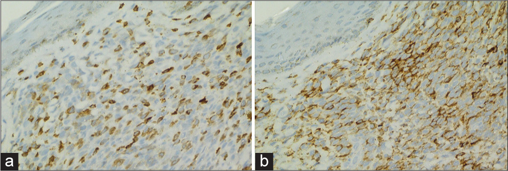 (a) Immunohistochemistry showed positivity of tumour cells for CD5. Immunohistochemistry (IHC) CD5 ×40. (b) Immunohistochemistry showed positivity of tumour cells for CD3. IHC CD3 ×40.