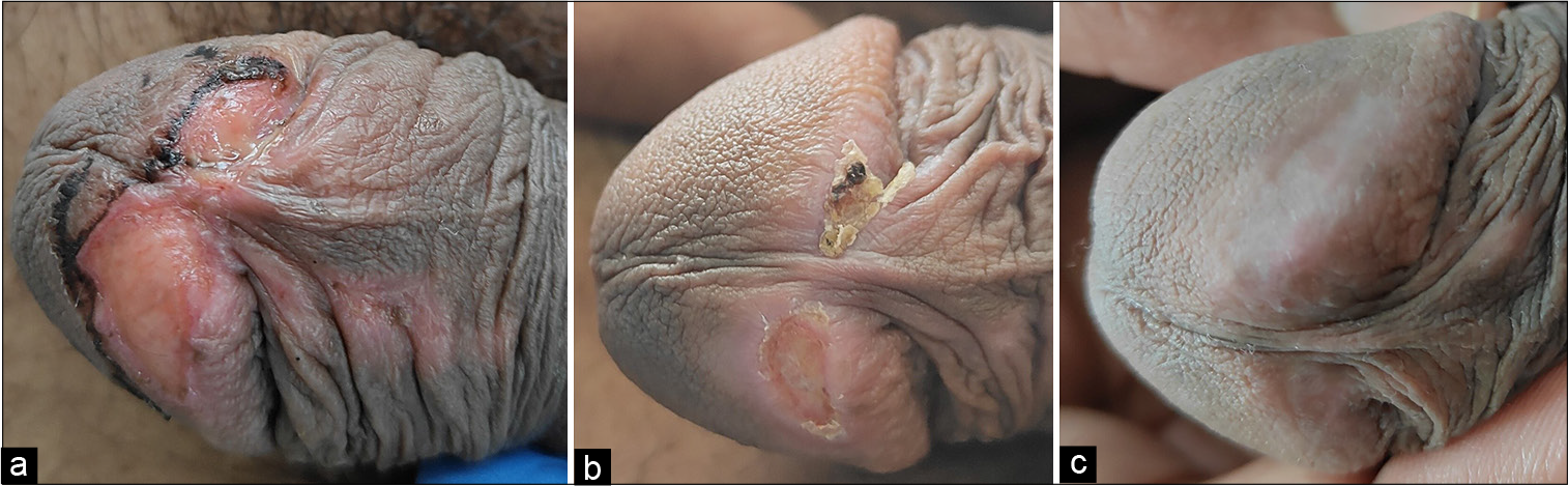 (a) A 3 × 1 single well-defined ulcer with clean floor and necrotic edges over glans penis. (b) Healing of ulcer at Day 3 of starting topical steroids, (c) Complete healing of ulcer at Day 7 of starting topical steroids.