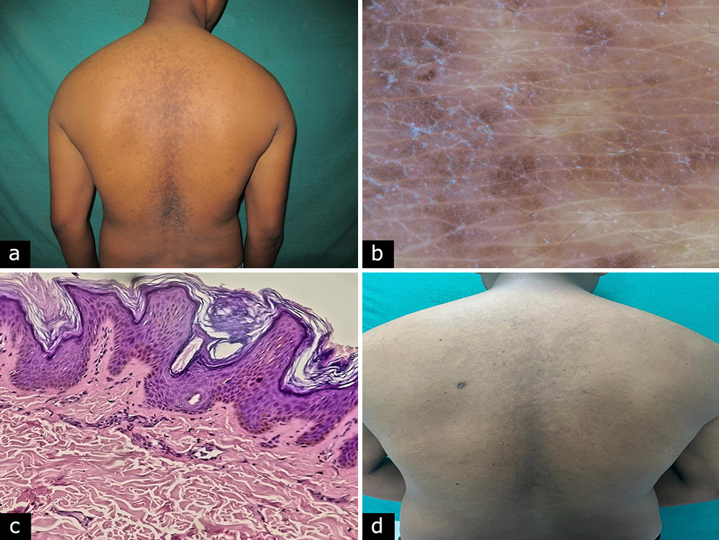 (a) Greyish-brown, scaly plaque over the back, confluent at the centre and reticulated at the periphery. (b) Dermoscopy with Dermlite DL4 under ×10 magnification revealed fine, whitish scaling and flat, light-brown globules in a cobblestone pattern. (c) hyperkeratosis, low broad papillomatosis, mild acanthosis, mild increase in melanin pigment and perivascular lymphocytic infiltration in dermis (haematoxylin and eosin, ×100). (d) Near complete improvement after treatment.