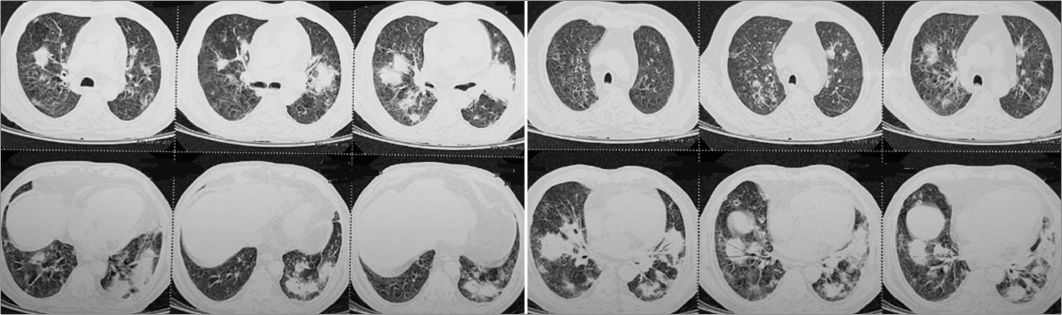 High-resolution computed tomography thorax showing bilateral, multifocal, well-defined round consolidations in middle and lower lobes with air-bronchogram or positive bronchus sign.