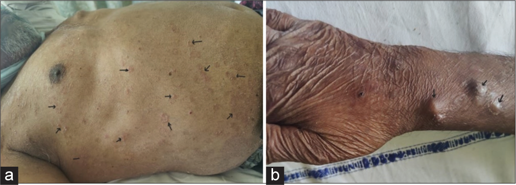 (a) Showing ill-defined erythematous plaques over anterior and posterior aspect of trunk and chest wall (black arrows), (b) showing multiple well-defined skin-coloured nodules noted over anterior aspect of forearm and wrist (black arrows).