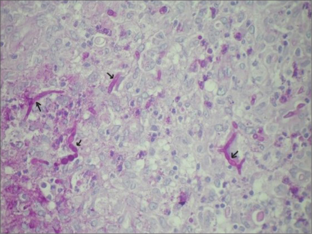 Histopathology showing segmented hyphae and spherical spore-like bodies in the dermis (black arrows). Periodic acid–Schiff (PAS) stain ×40.