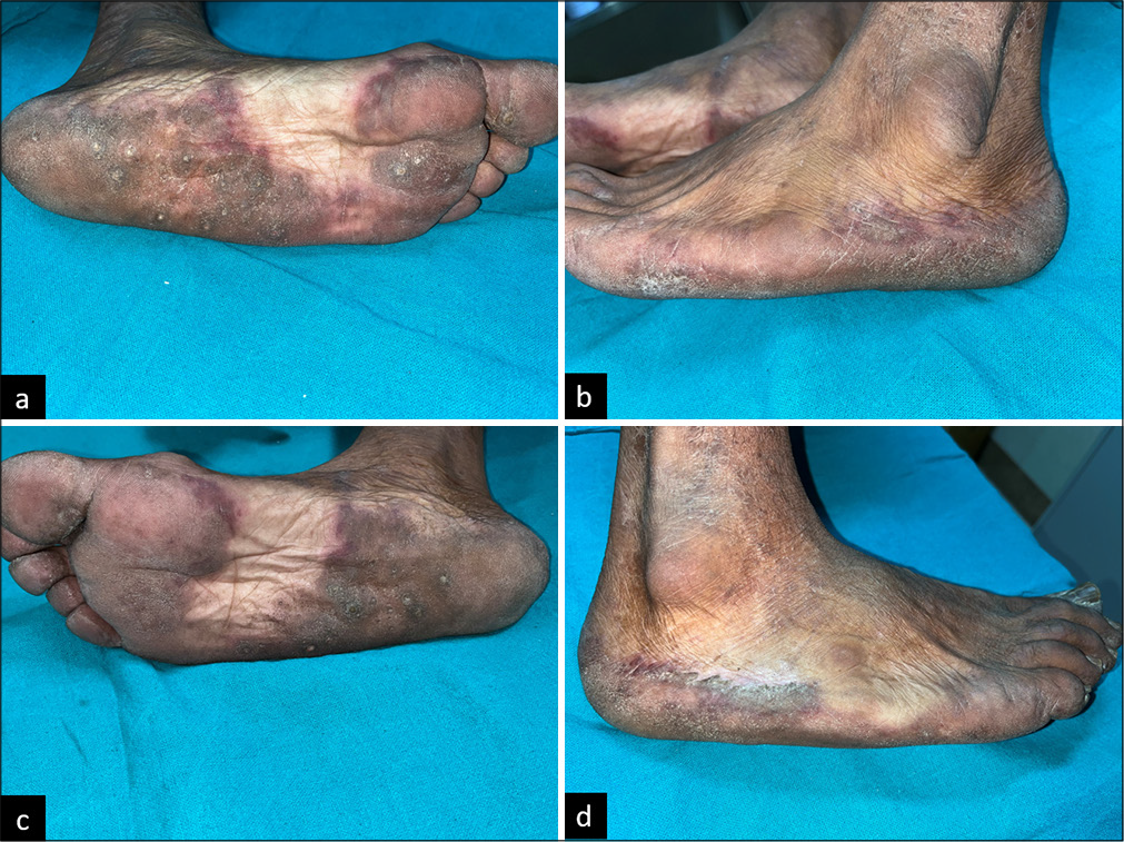 Left foot plantar aspect showing well-defined erythematous plaque with (a) multiple keratotic pitted papules, lateral border of left foot showing (b) prominent erythema, right foot plantar aspect showing well defined erythematous plaque with (c) multiple keratotic pitted papules and lateral border of right foot showing (d) prominent erythema.