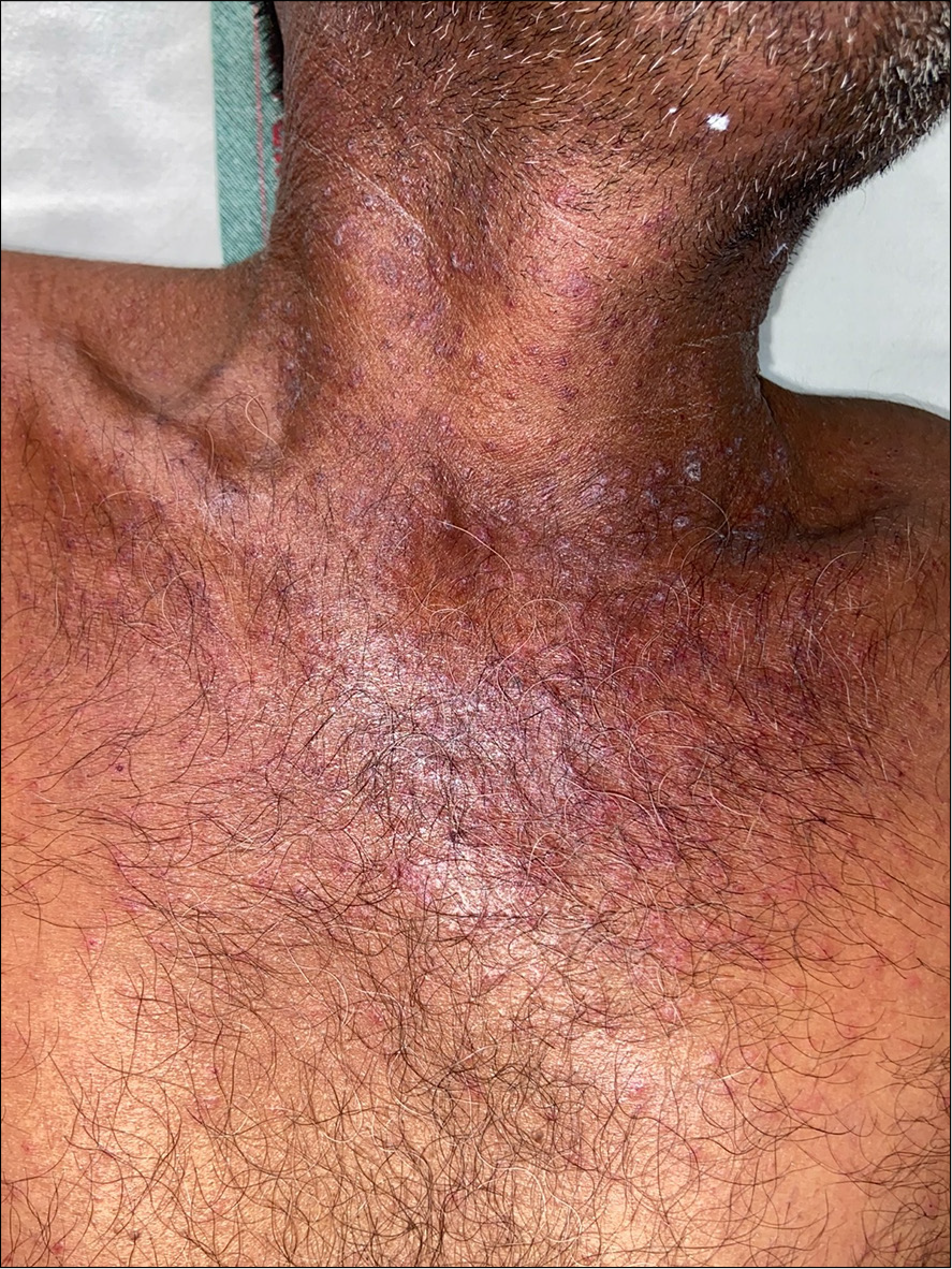 Erythematous maculopapular rash with crusting over neck and chest.