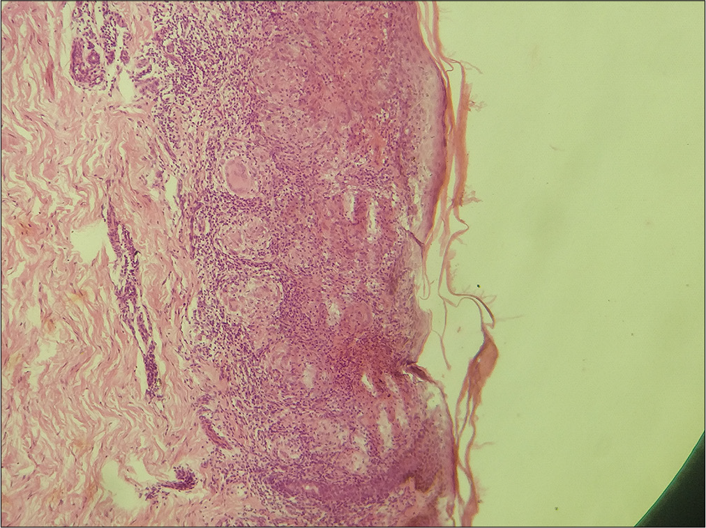 Histopathology image (Haematoxylin and eosin stain, ×40 magnification) shows focal basal cell vacuolisation and occasional apoptotic keratinocytes with moderate superficial and deep dermal periadenexal and perivascular oedema with mild lymphocytic infiltrate.