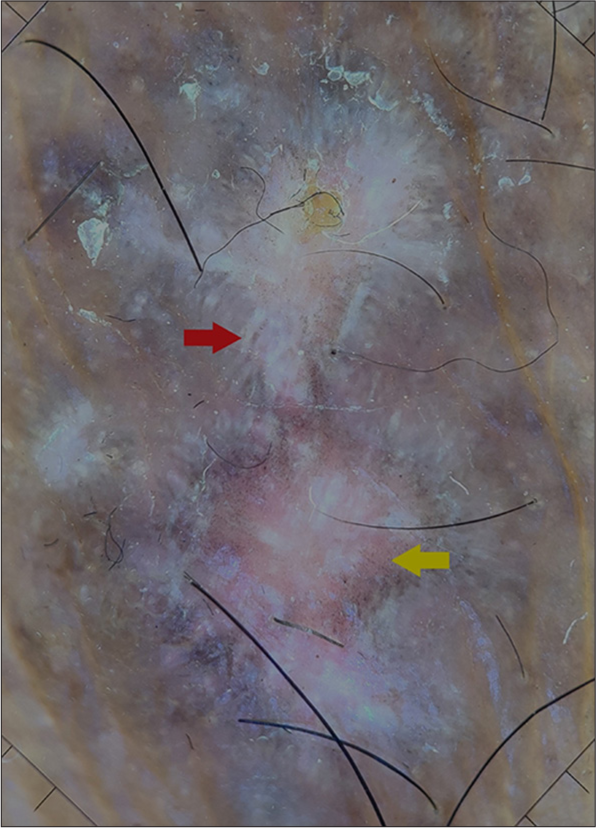 Dermoscopy showing a violaceous background with linear white streaks (Wickham’s striae, red arrow) and peripheral brown dots (yellow arrow) (FotoFinder™ systems GmbH, Bavaria, Germany. Polarised ×20).