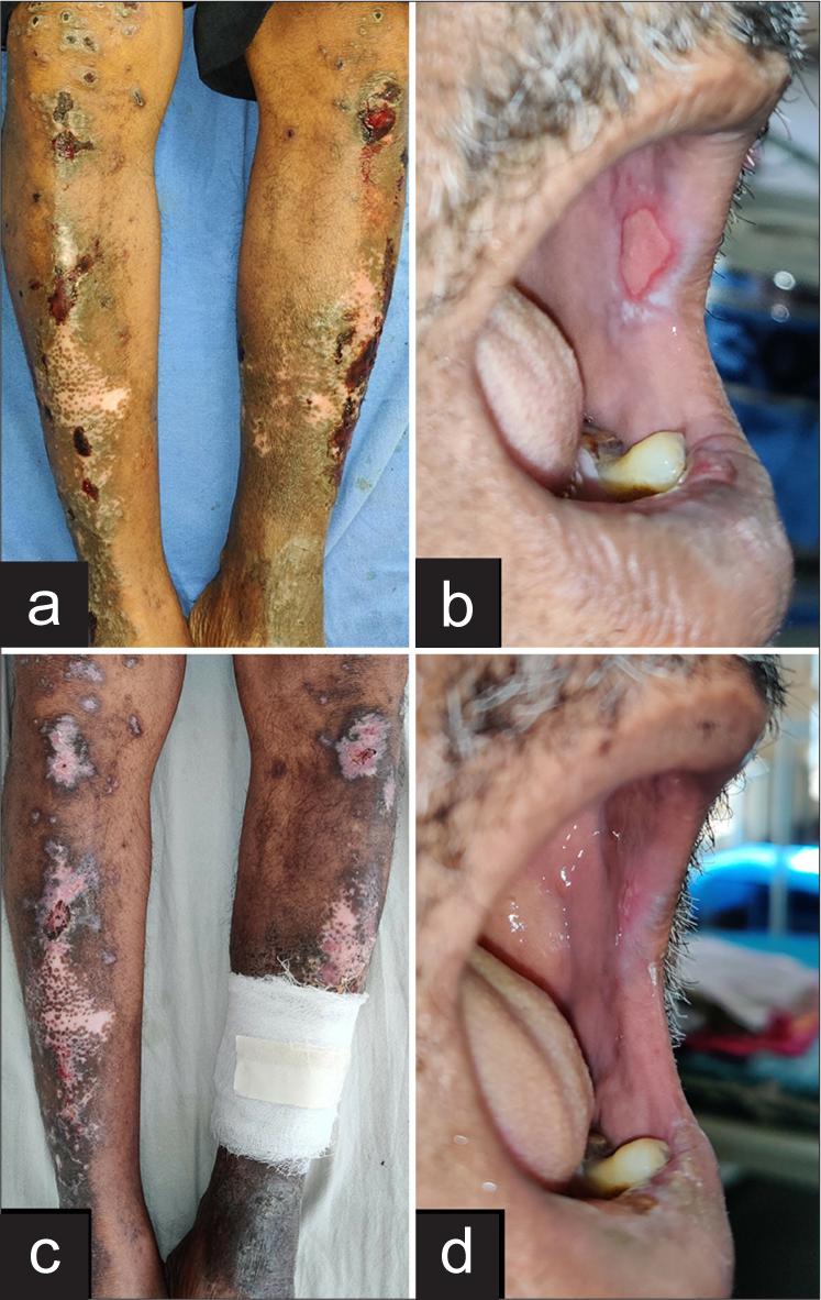 Clinical images showing (a) ulceration over lichen planus lesions over legs and (b) erosions in oral cavity at presentation (c) resolution of cutaneous ulceration and (d) resolution of erosions in oral cavity after 10 days of treatment initiation.