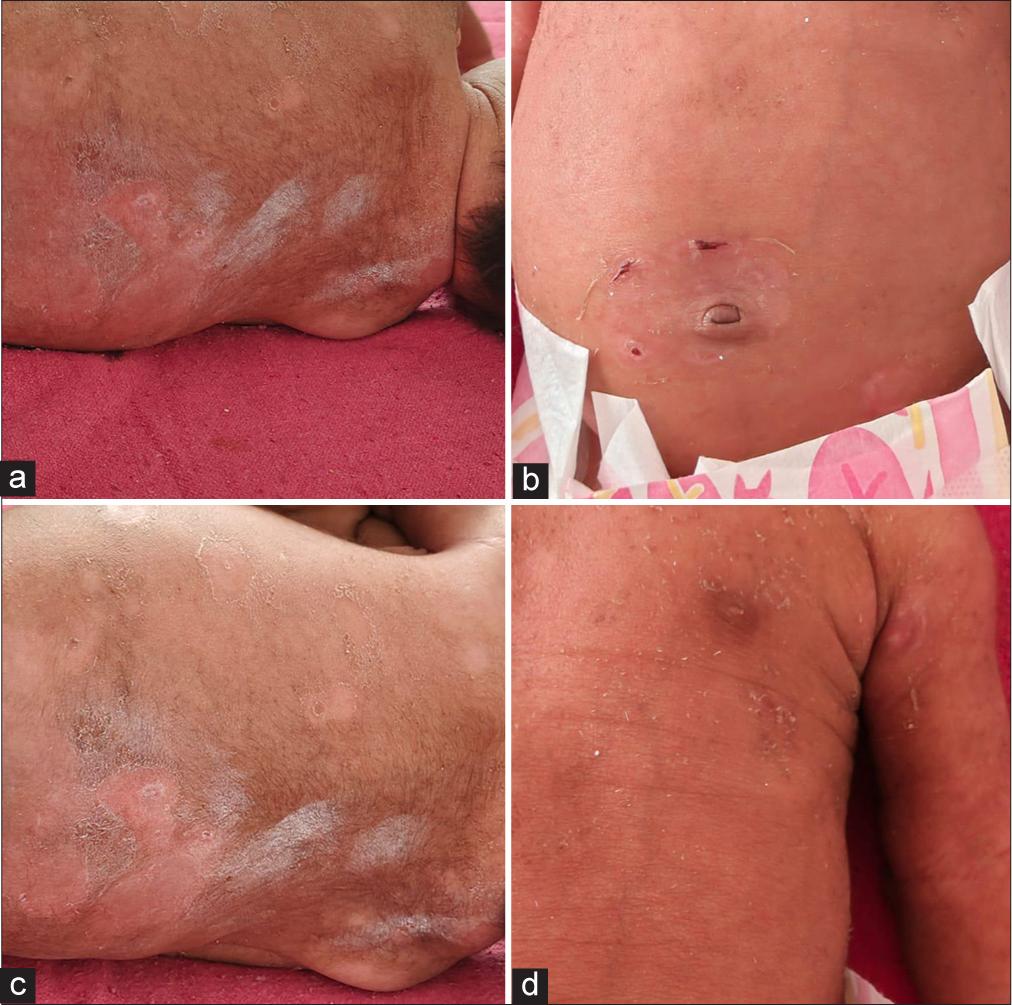 Day 7 after treatment - all erosions resolved completely. All lesions over the (a) back, (b) periumbilical region, (c) lateral aspect of chest and abdomen and (d) left axilla healed completely.