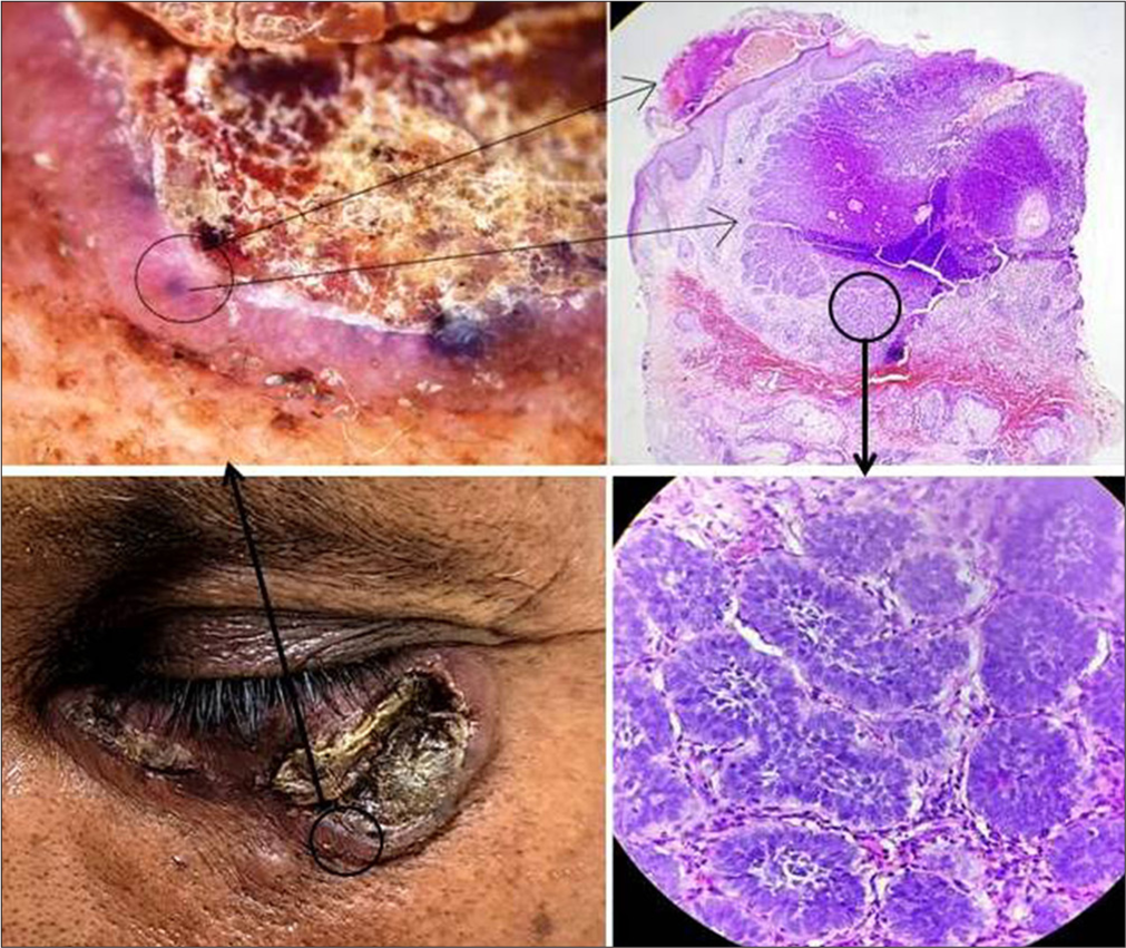 Illustration of dermoscopy directed biopsy in a case of basal cell carcinoma.