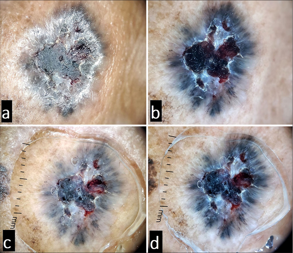 Illustration of the role of immersion fluid in dermoscopy. Panels (a and b) show non-polarised and polarised views, respectively, without linkage fluid. Panels (c and d) show nonpolarised and polarised views, respectively, with the use of linkage fluid. Polarised dermoscopy allows clearer visualisation of deeper structures while the non-polarised mode makes the surface features clearly visible. Note how the use of linkage fluid reduces the surface reflection (compare a and c). As the light from the dermoscope is trapped in the fluid, the use of linkage fluid also provides sharper views in both polarised mode (as more of the light is available for penetration into the skin) and non-polarised mode as compared to without using it (compare a and c, and b and d).