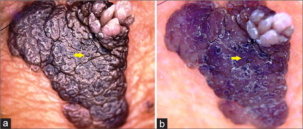Comedo-like structures (yellow arrows) in seborrheic keratosis “visible both in (a) non-polarised and (b) polarised modes. Being surface features, these structures appear more prominent in non-polarised mode.