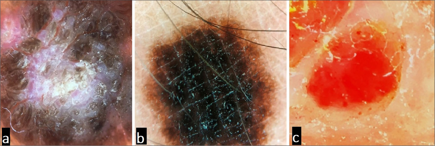 Basic chromophores in the skin: (a) keratin – primarily imparting white color, (b) melanin – primarily imparting black color, and (c) hemoglobin – primarily imparting red color.