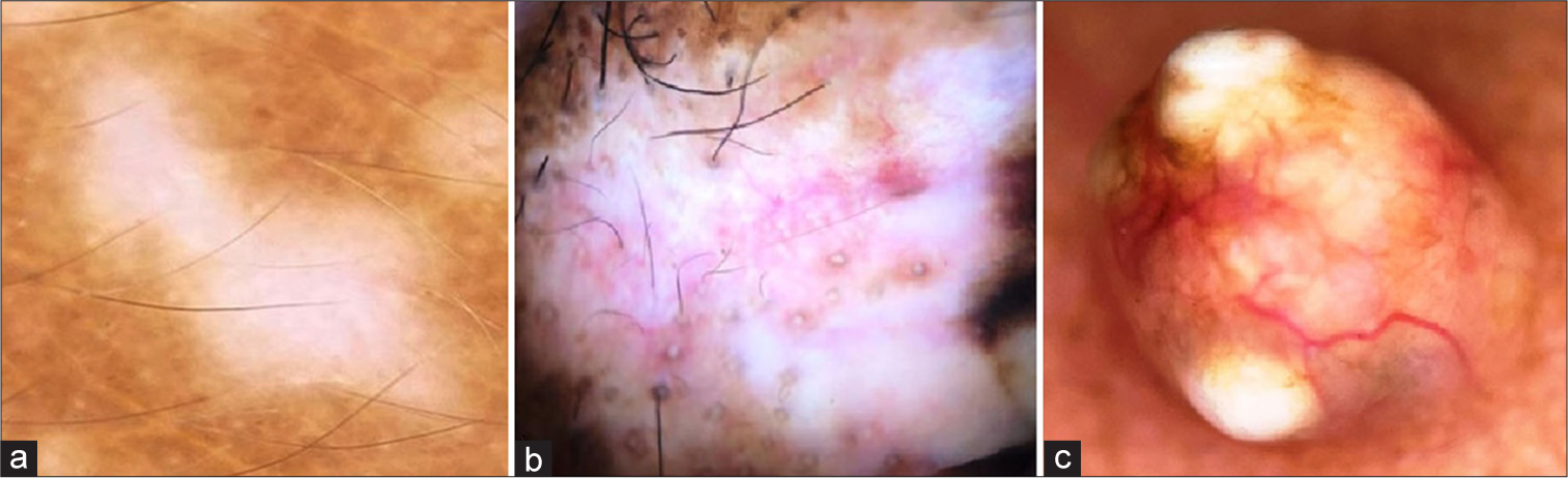 White color in dermoscopy due to (a) amelanosis in vitiligo, (b) dermal fibrosis in lichen sclerosus, and (c) calcinosis in pilomatricoma.