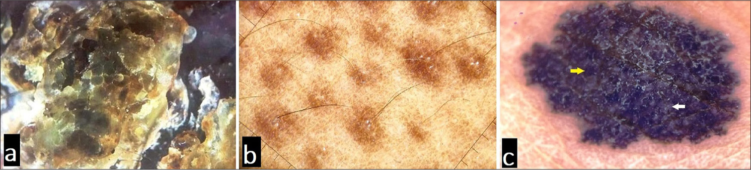 Illustration of various colors of melanin in dermoscopy based on its location: (a) black in stratum corneum, (b) brown in Malphigian layer, and (c) gray (white arrow) and blue (yellow arrow) colors due to its presence in papillary and reticular dermis, respectively.
