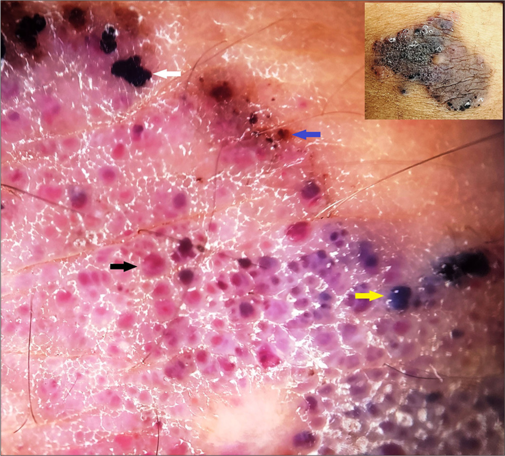 Illustration of various colors of hemoglobin in a vascular malformation: red color of oxygenated hemoglobin (black arrow), black (white arrow) and purple (yellow arrow) colors of deoxygenated hemoglobin, and brown color of residual hemosiderin (blue arrow). Inset – clinical image.
