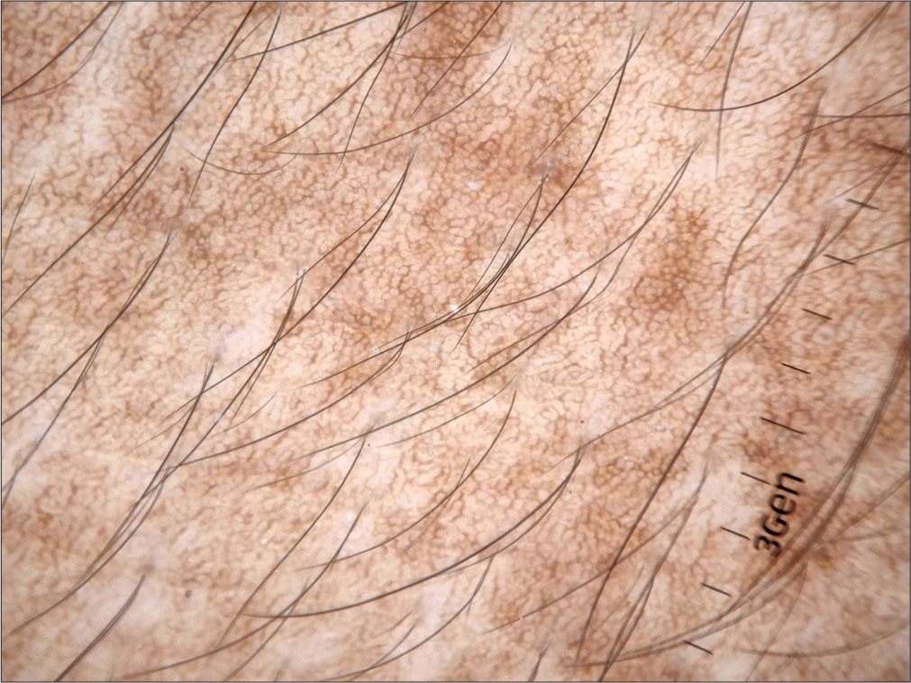 A typical pigment network (brown lines in a reticulate pattern) seen in a non-facial pigmented lesion.