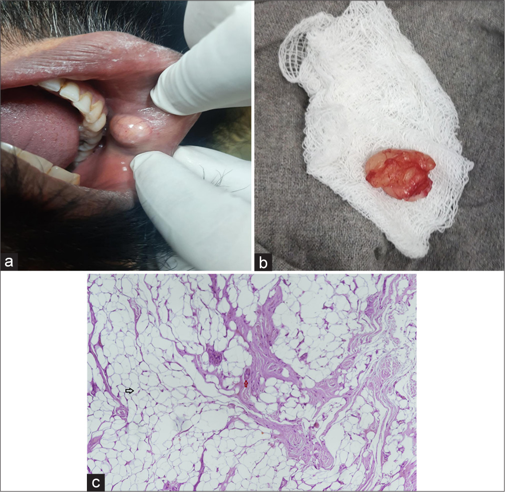 (a) A single well-defined swelling 1 × 1 cm on lower lip mucosa, soft, mobile, non-fluctuant, non-tender with normal overlying mucosal surface, (b) yellow-white soft-tissue mass of size 1 × 1 cm, soft to firm in consistency, (c) histopathological examination using haematoxylin and eosin stain at 40x maginification showing mature adipose tissue (black arrow) and hyaline globules in blood vessels (red arrow).