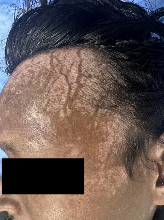 Salt and pepper pigmentation along with serpentine supravenous hyperpigmentation over forehead and temple area.