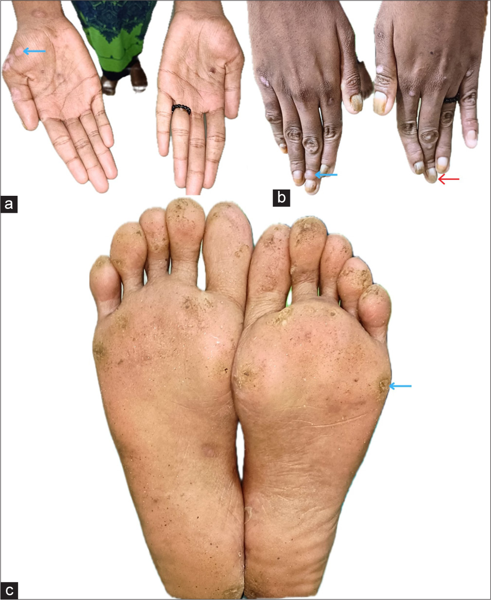 Clinical presentation of Patient 2. (a) Hypopigmented macules on the palms (blue arrow). (b) Tense bullae with clear fluid over the finger dorsa (blue arrow). Nail changes, including onychodystrophy (red arrow). (c) Hyperkeratotic calluses with brown crusts on the soles (blue arrow).