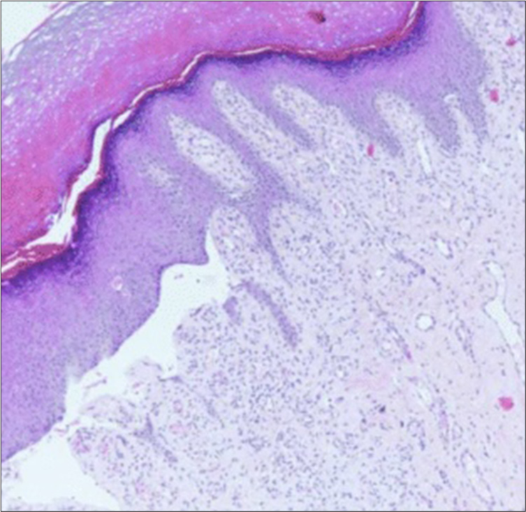 Histopathology: Suprabasal cleft in the epidermis, without inflammation (Haematoxylin and eosin stain, 10x).