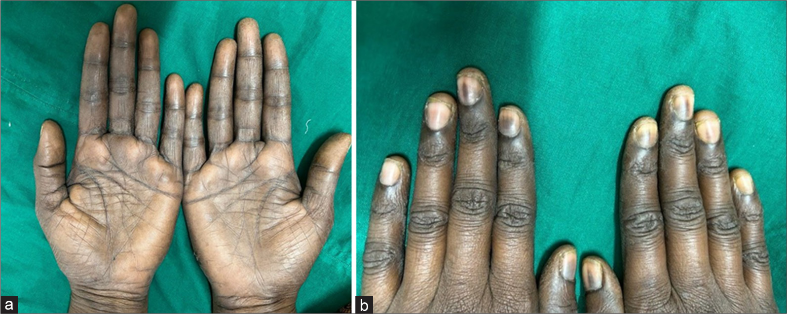 (a) Diffuse hyperpigmentation of the palms with scaling and increased pigmentation of the creases. (b) All the fingernails show bands of pigmentation.