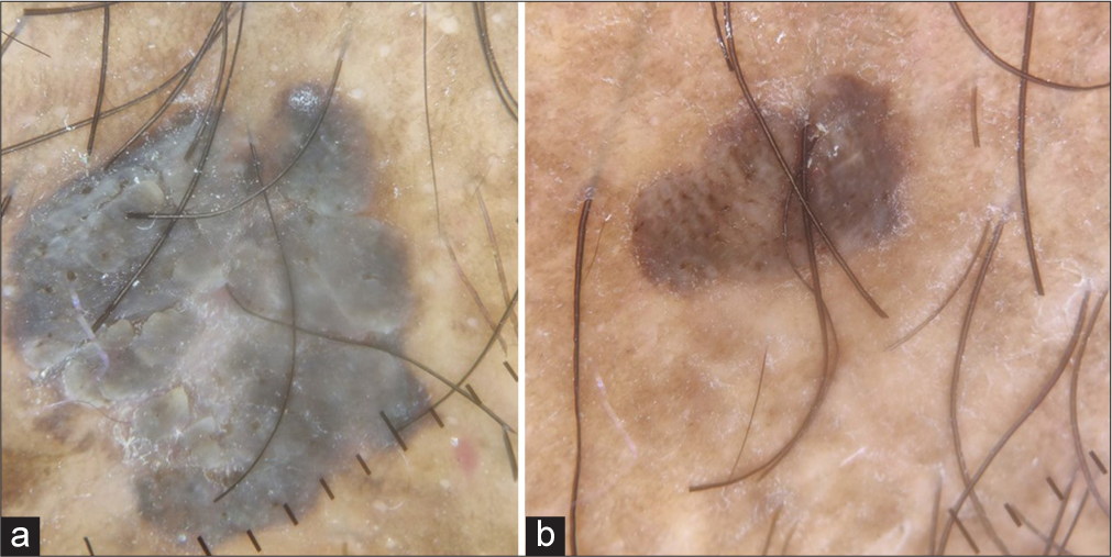 Dermoscopic examination of larger lesion revealed (a) presence of finger like exophytic papillary pattern, moth eaten borders, scales and comedo-like opening while the smaller lesion had (b) cerebriform pattern and few comedo-like openings on dermoscopic examination.