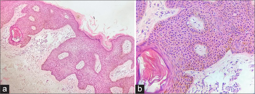Histopathological examination at low power (×10) (a) revealed acanthosis, hyperkeratosis and a horn cyst in epidermis suggesting seborrheic keratosis with a few atypical cells scattered along the epidermis suggesting Bowenoid transformation while, at high-power (×40), (b) epidermis appeared to be in disarray with atypical cells scattered throughout the thickness of epidermis and poorly formed keratin pearls.